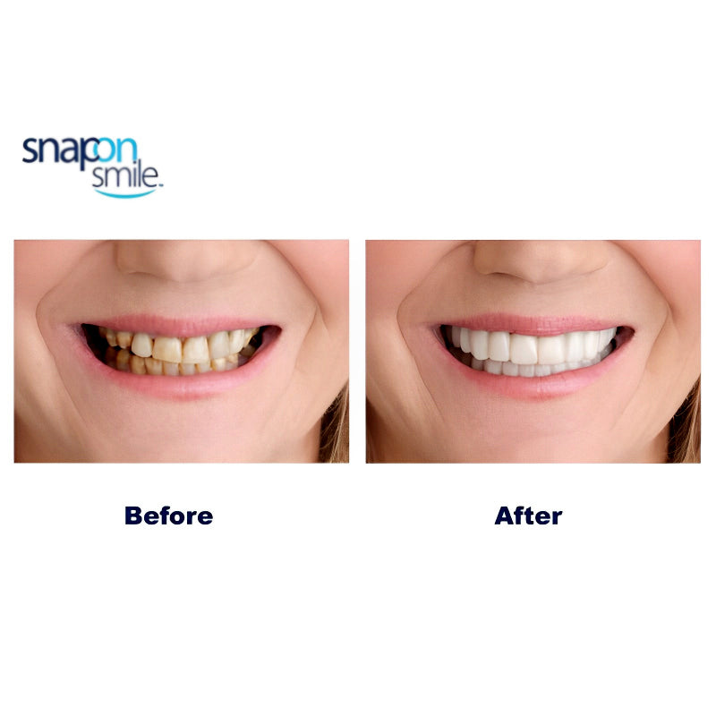 Pack Of 2 Pairs Snap-On Smile Custom Fit Perfect Smile Veneers In 3 Easy Steps