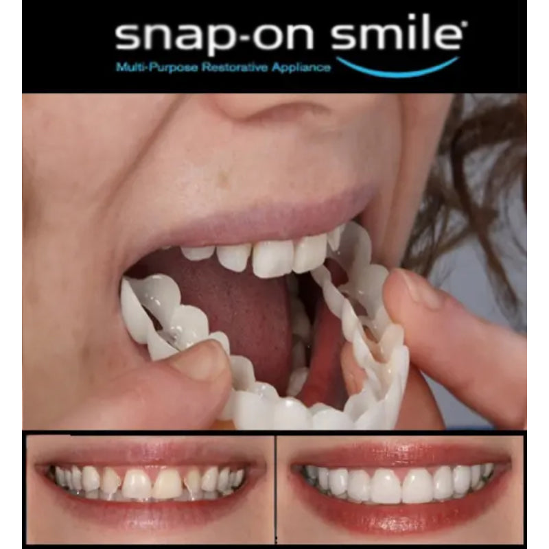 Pack Of 2 Pairs Snap-On Smile Custom Fit Perfect Smile Veneers In 3 Easy Steps